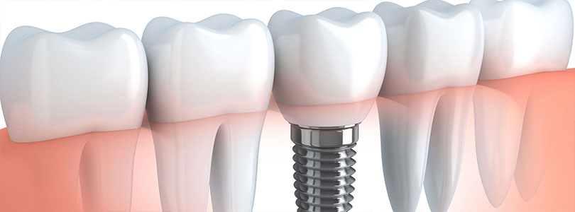 Implants dentaires