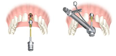 Pose de l'implant dentaire